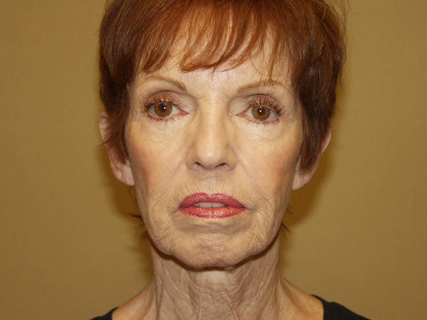 Facelift Patient 11 Before 1