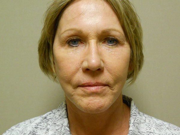 Facelift Patient 12 After 1