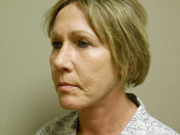 Facelift Patient 12 After 2