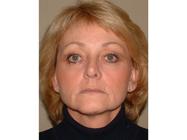 FaceLift Patient 16 After 1