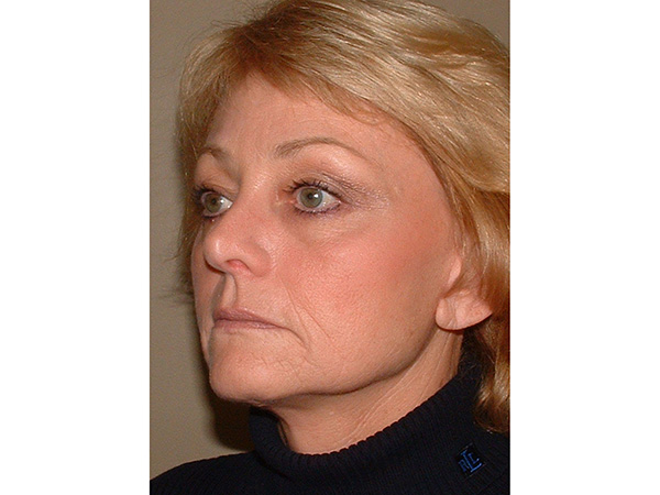 FaceLift Patient 16 After 2