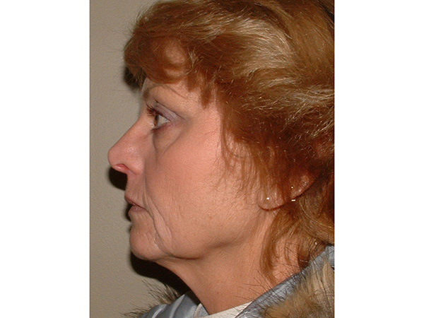 FaceLift Patient 16 Before 3