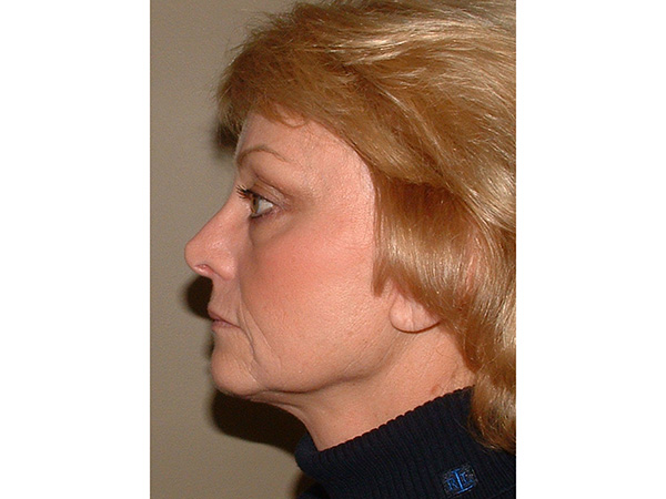FaceLift Patient 16 After 3