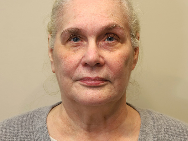 FaceLift Patient 15 Before 1