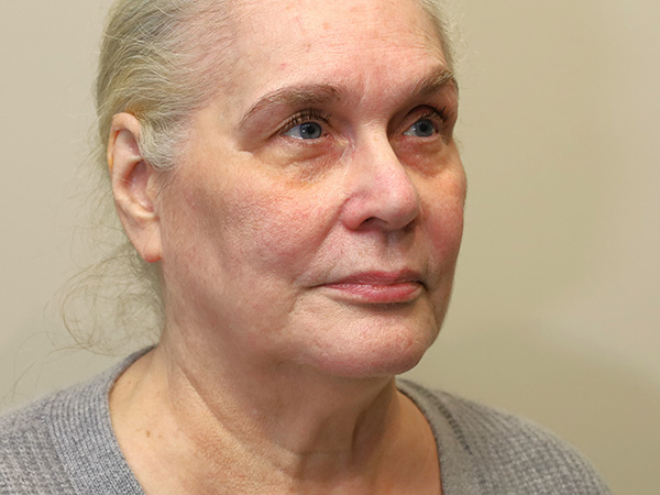 FaceLift Patient 15 Before 2