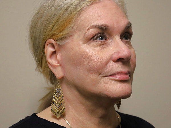 FaceLift Patient 15 After 2