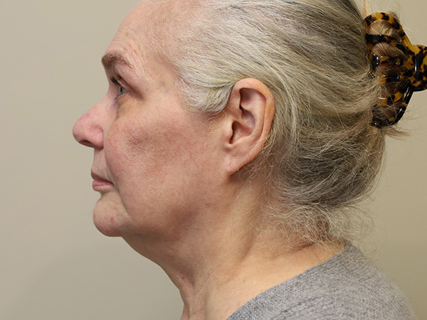 FaceLift Patient 15 Before 3