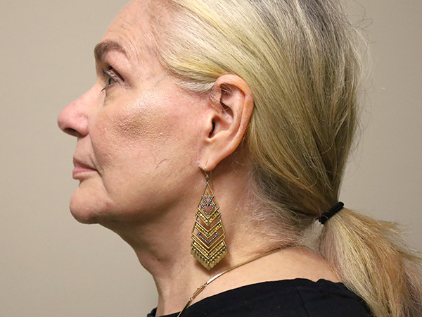 FaceLift Patient 15 After 3