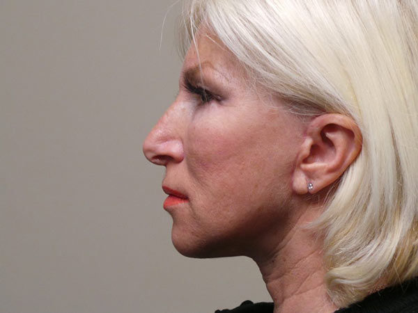 FaceLift Patient 04 After 1