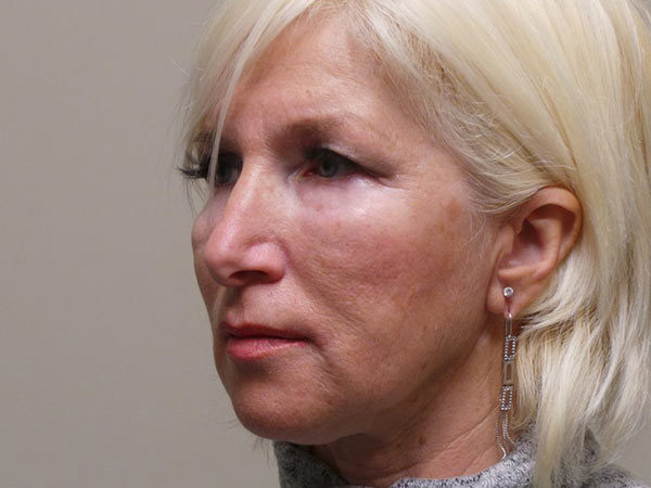 FaceLift Patient 04 Before 2