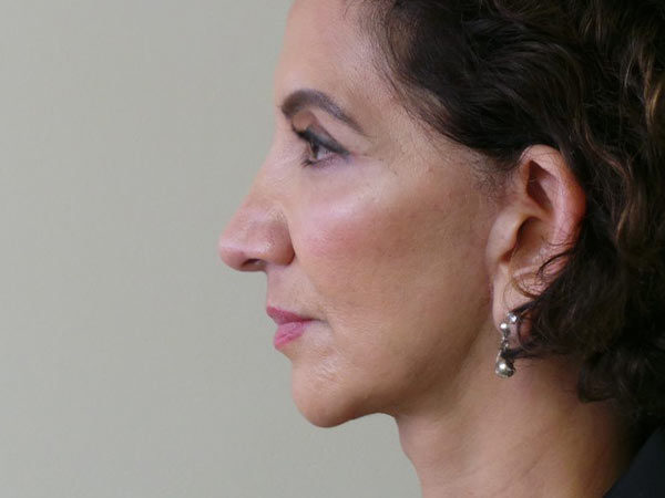 FaceLift Patient 05 Before 1