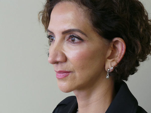 FaceLift Patient 05 Before 2