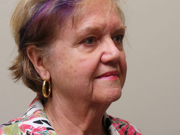 FaceLift Patient 06 Before 2