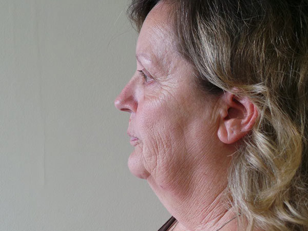 FaceLift Patient 07 Before 2