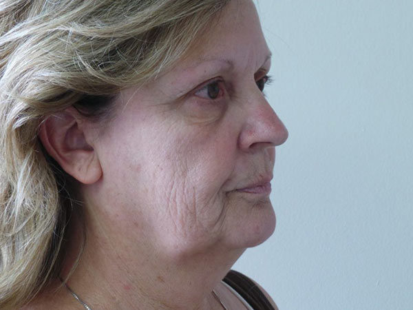 FaceLift Patient 07 Before 1