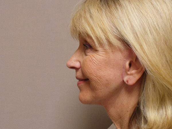 FaceLift Patient 13 After 1