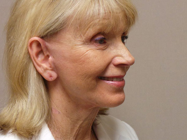 FaceLift Patient 13 After 2