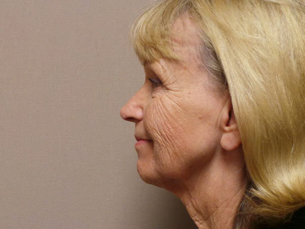 FaceLift Patient 13 Before 1