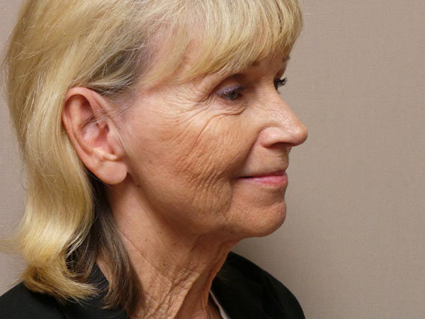 FaceLift Patient 13 Before 2