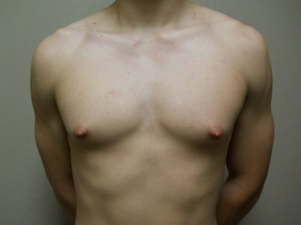 Gynecomastia Patient 09 Before 1