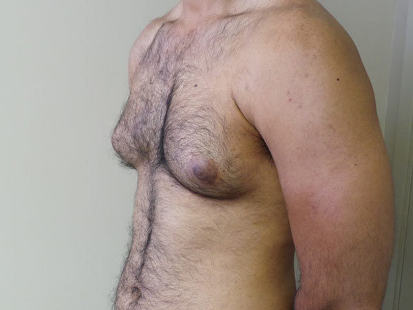 Gynecomastia Patient 10 Before 2
