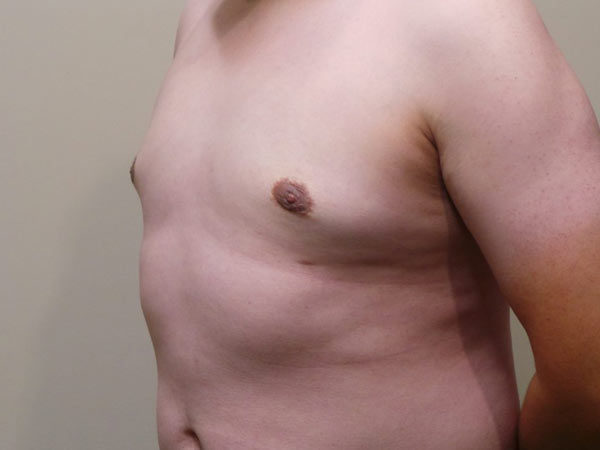Gynecomastia Patient 02 After 1