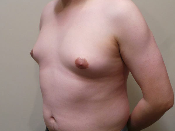 Gynecomastia Patient 02 Before 1
