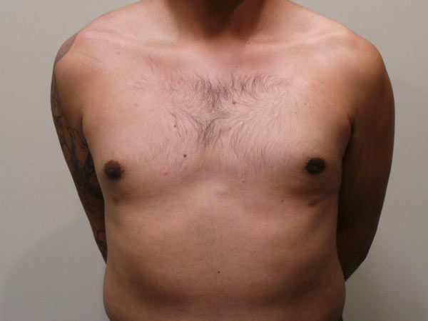 Gynecomastia Patient 06 After 1
