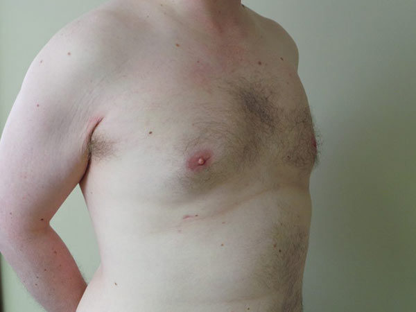 Gynecomastia Patient 03 After 2