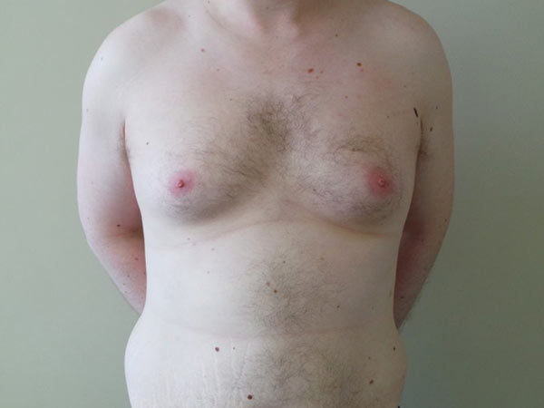 Gynecomastia Patient 03 Before 1