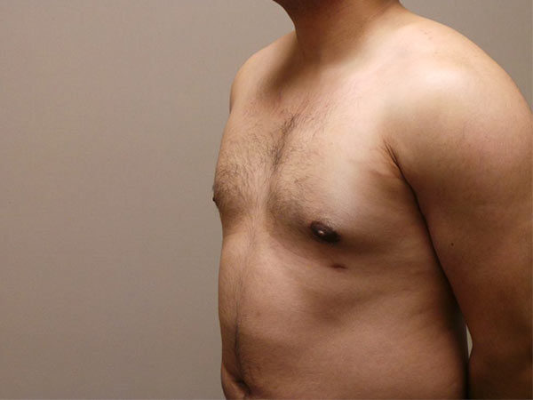 Gynecomastia Patient 05 After 2