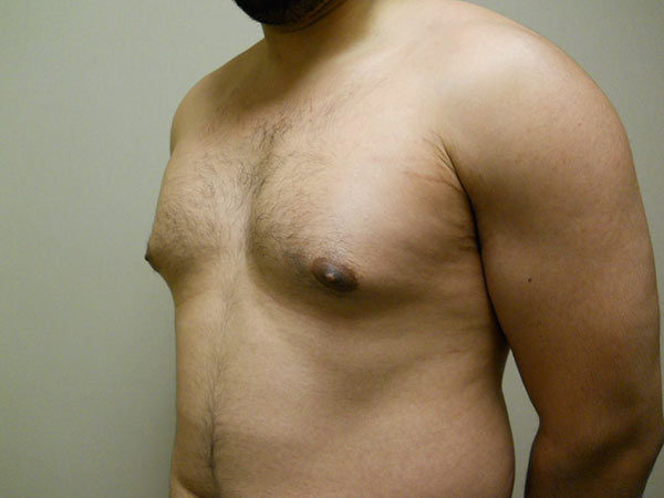 Gynecomastia Patient 05 Before 2