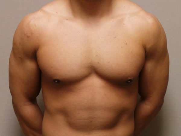 Gynecomastia Patient 07 After 1