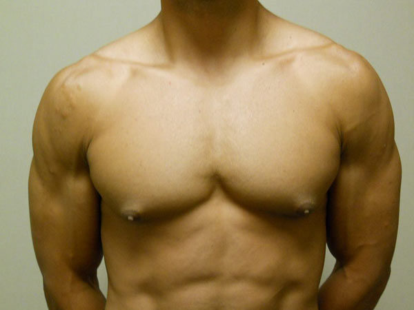 Gynecomastia Patient 07 Before 1