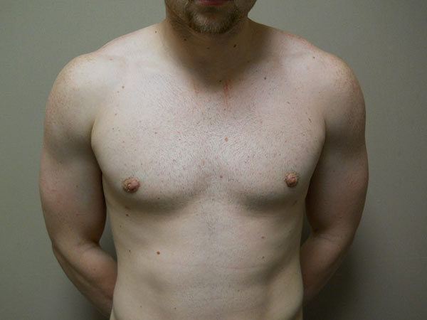 Gynecomastia Patient 08 After 1