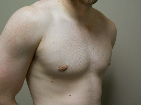 Gynecomastia Patient 08 After 2