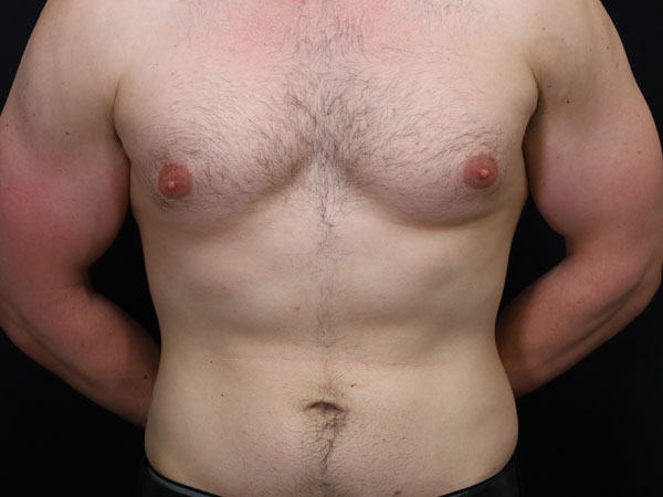 Gynecomastia Patient 14 Before 1
