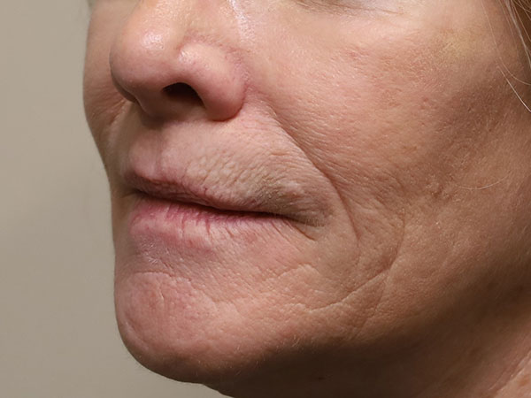 Lip Implant 01 Before 2