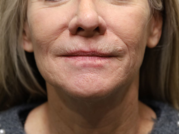 Lip Implant 01 Before 1