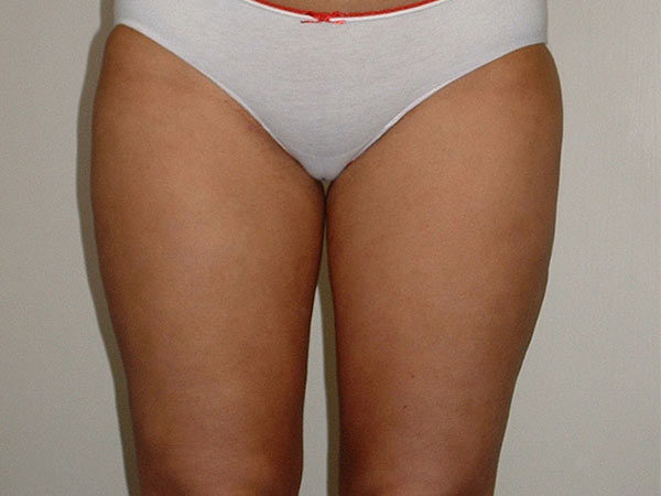 Liposuction Patient 03 After 1