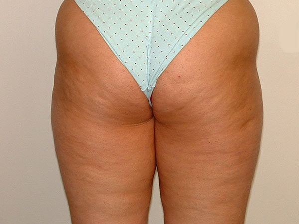 Liposuction Patient 03 Before 2
