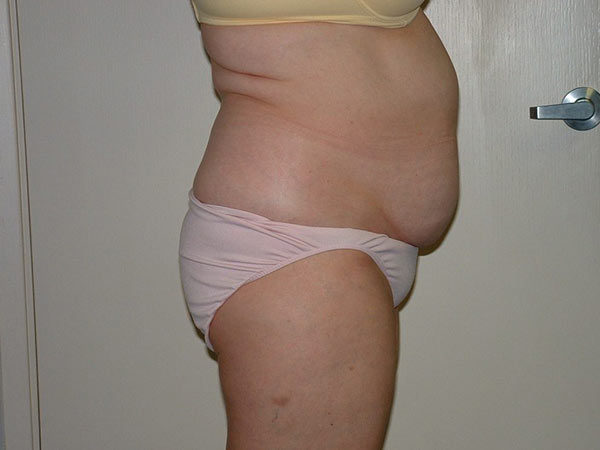 Liposuction Patient 07 Before 2