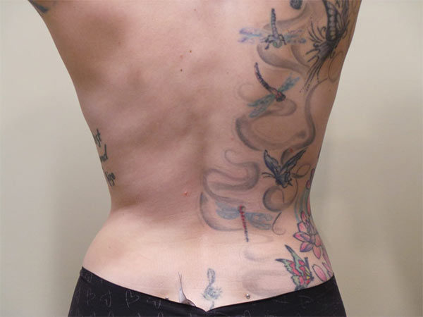 Liposuction Patient 01 After 2