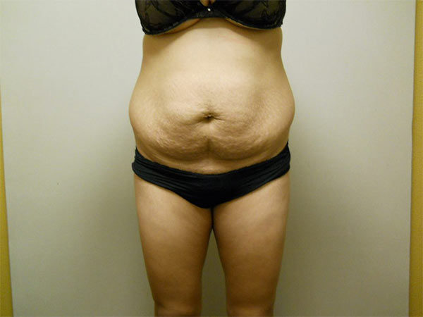 Liposuction Patient 06 Before 1