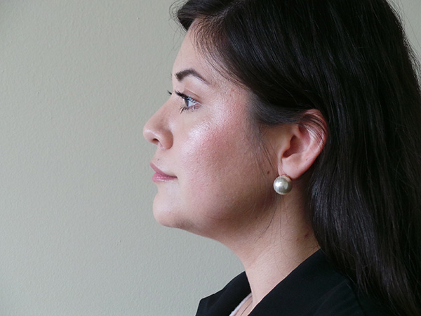 Liposuction Patient 09 Before 1