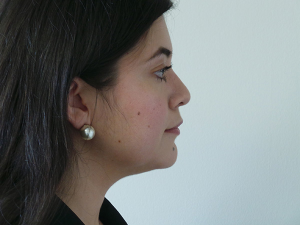 Liposuction Patient 09 Before 2