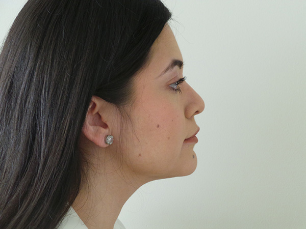 Liposuction Patient 09 After 2