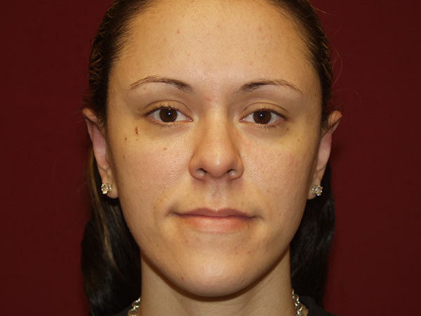 Otoplasty Patient 05 After 1