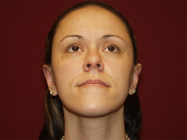 Otoplasty Patient 05 After 2