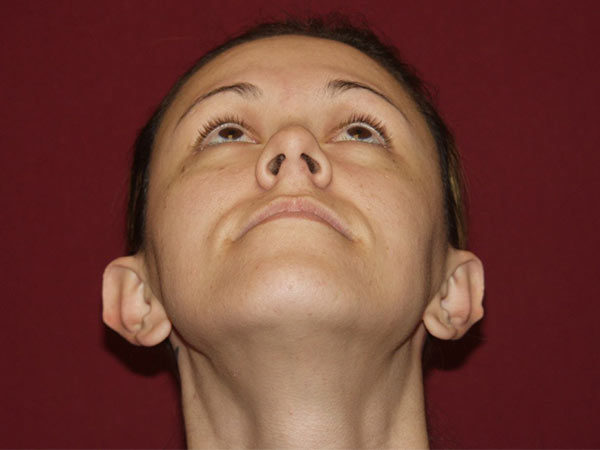 Otoplasty Patient 05 Before 2